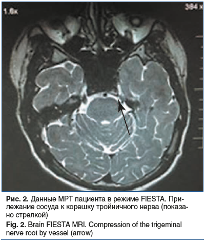 Рис. 2. Данные МРТ пациента в режиме FIESTA. При- лежание сосуда к корешку тройничного нерва (показано стрелкой) Fig. 2. Brain FIESTA MRI. Compression of the trigeminal nerve root by vessel (arrow)