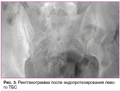 Рис. 3. Рентгенограмма после эндопротезирования левого ТБС