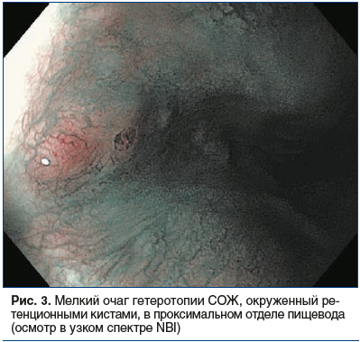 Рис. 3. Мелкий очаг гетеротопии СОЖ, окруженный ретенционными кистами, в проксимальном отделе пищевода (осмотр в узком спектре NBI)