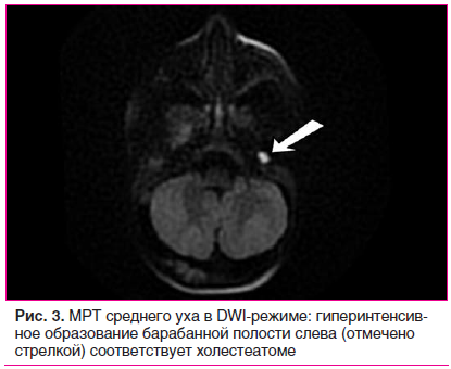 Рис. 3. МРТ среднего уха в DWI-режиме: гиперинтенсивное образование барабанной полости слева (отмечено стрелкой) соответствует холестеатоме