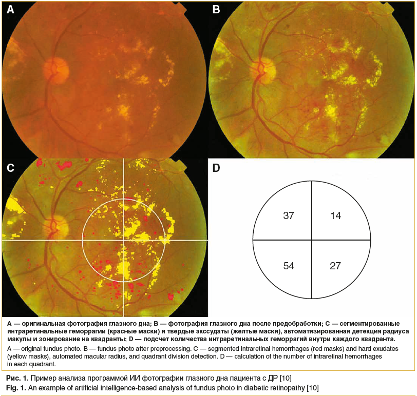Рис. 1. Пример анализа программой ИИ фотографии глазного дна пациента с ДР [10]Fig. 1. An example of artificial intelligence-based analysis of fundus photo in diabetic retinopathy [10]