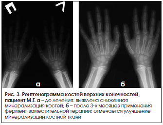 Рис. 3. Рентгенограмма костей верхних конечностей, пациент М.Г.