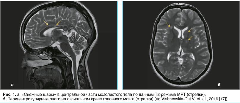Рис. 1. a. «Снежные шары» в центральной части мозолистого тела по данным Т2-режима МРТ (стрелки); б. Перивентрикулярные очаги на аксиальном срезе головного мозга (стрелки) (по Vishnevskia-Dai V. et. al., 2016 [17])