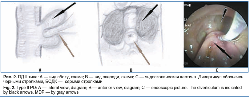 Рис. 2. ПД II типа: А — вид сбоку, схема; В — вид спереди, схема; С — эндоскопическая картина. Дивертикул обозначен черными стрелками, БСДК — серыми стрелками Fig. 2. Type II PD: A — lateral view, diagram; B — anterior view, diagram; C — endoscopic pictur