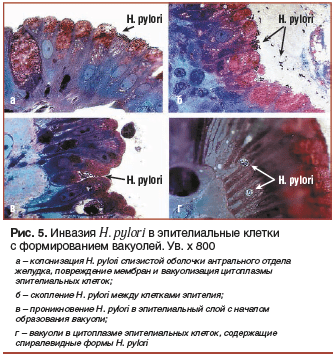 Рис. 5. Инвазия H. pylori в эпителиальные клетки с формированием вакуолей. Ув. х 800