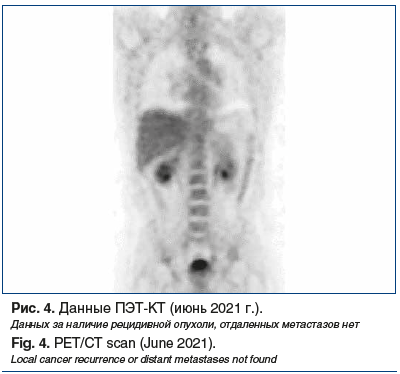 Рис. 4. Данные ПЭТ-КТ (июнь 2021 г.). Данных за наличие рецидивной опухоли, отдаленных метастазов нет Fig. 4. PET/CT scan (June 2021). Local cancer recurrence or distant metastases not found