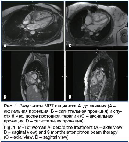 Рис. 1. Результаты МРТ пациентки А. до лечения (А – аксиальная проекция, В – сагиттальная проекция) и спустя 8 мес. после протонной терапии (C – аксиальная проекция, D – сагиттальная проекция) Fig. 1. MRI of woman A. before the treatment (A – axial view, 