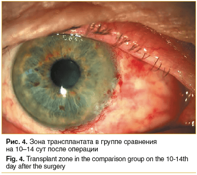 Рис. 4. Зона трансплантата в группе сравнения на 10–14 сут после операции