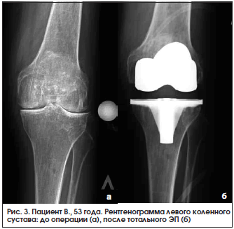Рис. 3. Пациент В., 53 года. Рентгенограмма левого коленного сустава: до операции (а), после тотального ЭП (б)