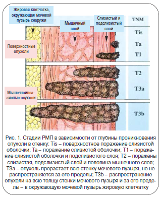 Рис. 1. Стадии РМП в зависимости от глубины проникновения опухоли в стенку