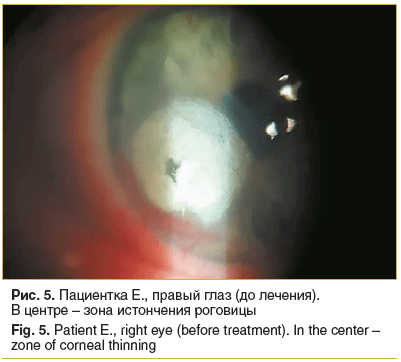 Рис. 5. Пациентка Е., правый глаз (до лечения). В центре – зона истончения роговицы