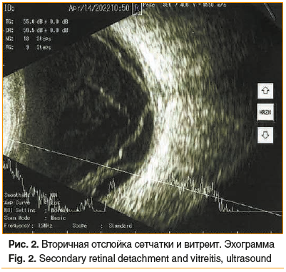 Рис. 2. Вторичная отслойка сетчатки и витреит. Эхограмма Fig. 2. Secondary retinal detachment and vitreitis, ultrasound