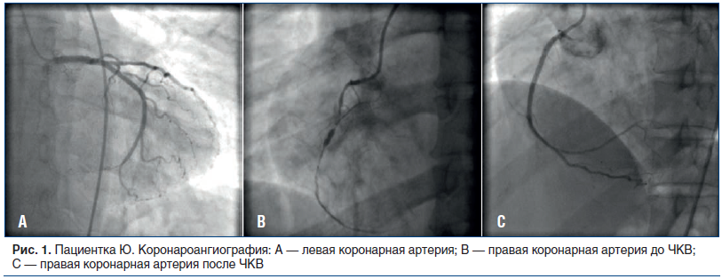 Рис. 1. Пациентка Ю. Коронароангиография: А — левая коронарная артерия; B — правая коронарная артерия до ЧКВ; С — правая коронарная артерия после ЧКВ