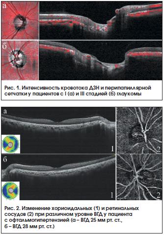 Рис. 1. Интенсивность кровотока ДЗН и перипапиллярнойсетчатки у пациентов с I (а) и III стадией (б) глаукомы