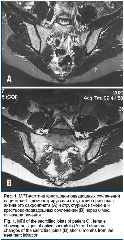 Рис. 1. МРТ-картина крестцово-подвздошных сочленений пациентки Г., демонстрирующая отсутствие признаков активного сакроилиита (A) и структурных изменений крестцово-подвздошных сочленений (B) через 6 мес. от начала лечения Fig. 1. MRI of the sacroiliac joi