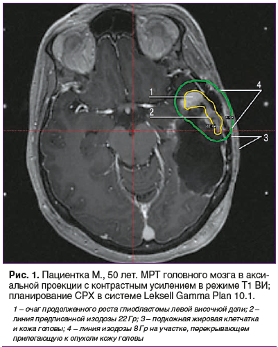 Рис. 1. Пациентка М., 50 лет. МРТ головного мозга в аксиальной проекции с контрастным усилением в режиме Т1 ВИ; планирование СРХ в системе Leksell Gamma Plan 10.1.
