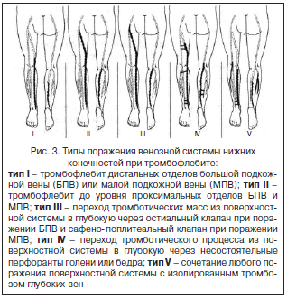Рис. 3. Типы поражения венозной системы нижних конечностей при тромбофлебите