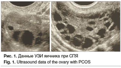 Рис. 1. Данные УЗИ яичника при СПЯ Fig. 1. Ultrasound data of the ovary with PCOS