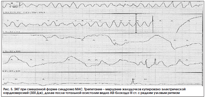 Рис. 5. ЭКГ при смешанной форме синдрома МАС. Трепетание – мерцание желудочков купировано электрической кардиоверсией (300 Дж), далее после тотальной асистолии видна АВ-блокада III ст. с редким узловым ритмом