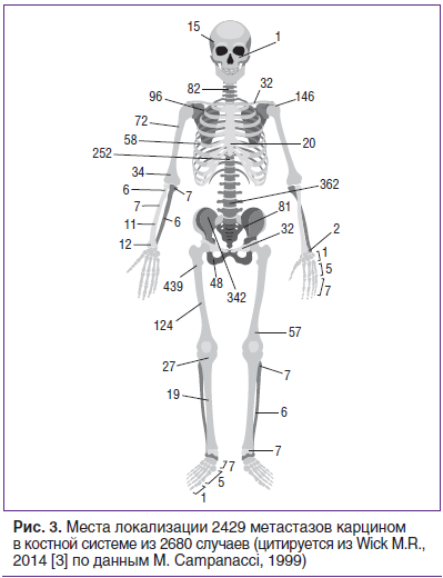 Рис. 3. Места локализации 2429 метастазов карцином в костной системе из 2680 случаев (цитируется из Wick M.R., 2014 [3] по данным M. Campanacci, 1999)