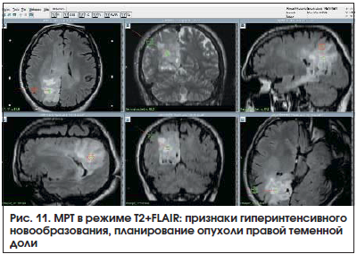 Рис. 11. МРТ в режиме T2+FLAIR: признаки гиперинтенсивного новообразования, планирование опухоли правой теменной доли