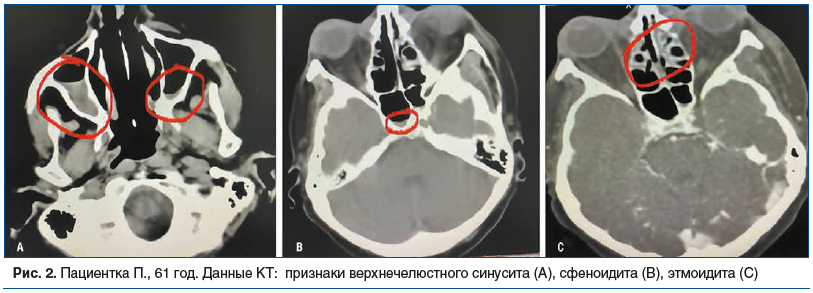 Рис. 2. Пациентка П., 61 год. Данные КТ: признаки верхнечелюстного синусита (A), сфеноидита (B), этмоидита (C)
