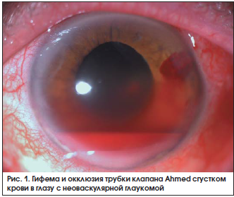 Рис. 1. Гифема и окклюзия трубки клапана Ahmed сгустком крови в глазу с неоваскулярной глаукомой