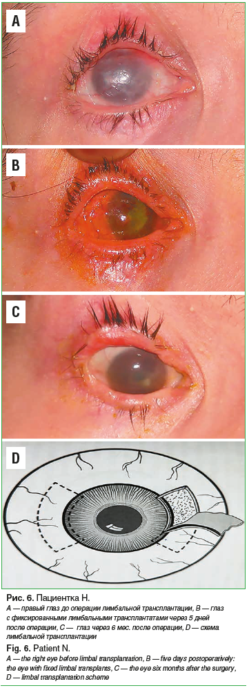 Рис. 6. Пациентка Н. А — правый глаз до операции лимбальной трансплантации, B — глаз с фиксированными лимбальными трансплантатами через 5 дней после операции, C — глаз через 6 мес. после операции, D — схема лимбальной трансплантации Fig. 6. Patient N. A —