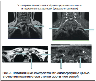 Рис. 6. Нативная (без контраста) МР-ангиография с целью уточнения наличия отека стенки аорты и ее ветвей