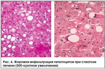 Рис. 4. Жировая инфильтрация гепатоцитов при стеатозе печени (500-кратное увеличение)