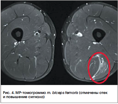 Рис. 4. МР-томограмма m. biceps femoris (отмечены отек и повышение сигнала)