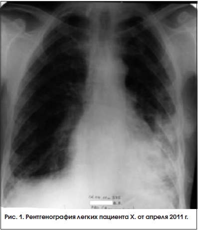 Рис. 1. Рентгенография легких пациента Х. от апреля 2011 г.