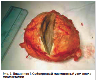Рис. 3. Пациентка Г. Субсерозный миоматозный узел после миомэктомии