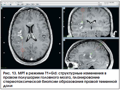 Рис. 13. МРТ в режиме T1+Gd: структурные изменения в правом полушарии головного мозга, планирование стереотаксической биопсии образования правой теменной доли