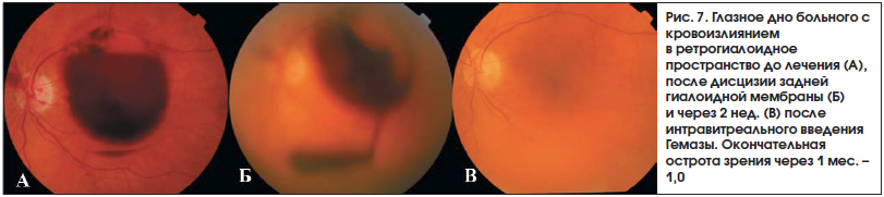 Рис. 7. Глазное дно больного с кровоизлиянием в ретрогиалоидное пространство до лечения (А), после дисцизии задней гиалоидной мембраны (Б) и через 2 нед. (В) после интравитреального введения Гемазы. Окончательная острота зрения через 1 мес. – 1,0