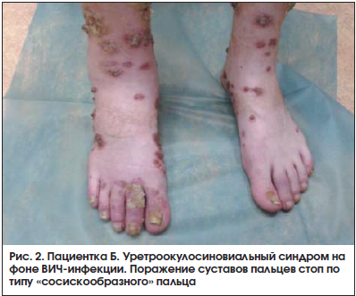 Рис. 2. Пациентка Б. Уретроокулосиновиальный синдром на фоне ВИЧ-инфекции. Поражение суставов пальцев стоп по типу «сосискообразного» пальца