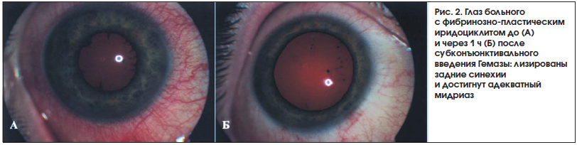Рис. 2. Глаз больного с фибринозно-пластическим иридоциклитом до (А) и через 1 ч (Б) после субконъюнктивального введения Гемазы: лизированы задние синехии и достигнут адекватный мидриаз