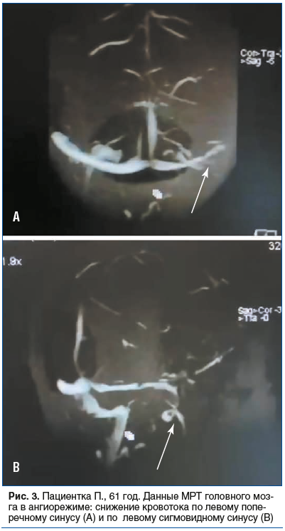 Рис. 3. Пациентка П., 61 год. Данные МРТ головного мозга в ангиорежиме: снижение кровотока по левому попе- речному синусу (A) и по левому сигмовидному синусу (B)