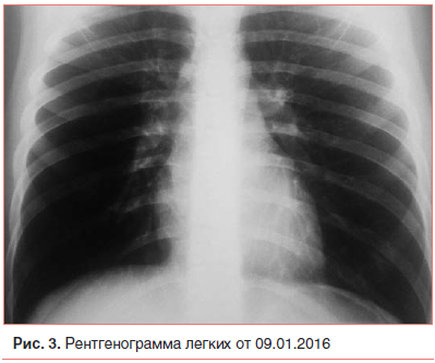 Рис. 3. Рентгенограмма легких от 09.01.2016