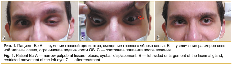 Рис. 1. Пациент Б.: А — сужение глазной щели, птоз, смещение глазного яблока слева. В — увеличение размеров слез- ной железы слева, ограничение подвижности OS. С — состояние пациента после лечения Fig. 1. Patient B.: A — narrow palpebral fissure, ptosis, 