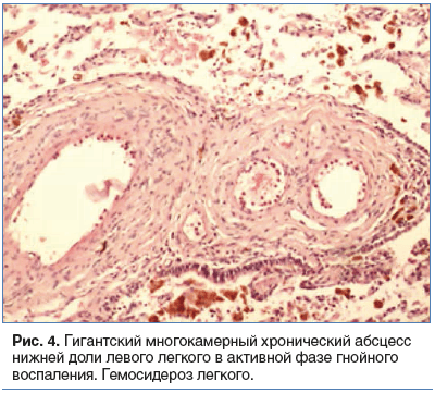 Рис. 4. Гигантский многокамерный хронический абсцесс нижней доли левого легкого в активной фазе гнойного воспаления. Гемосидероз легкого.