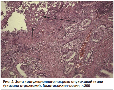 Рис. 2. Зона коагуляционного некроза опухолевой ткани (указано стрелками). Гематоксилин-эозин, ×200