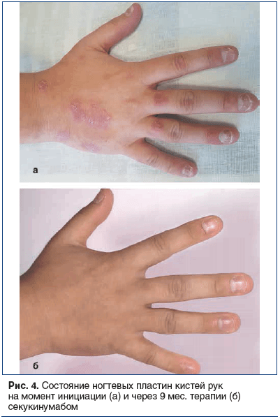Рис. 4. Состояние ногтевых пластин кистей рук на момент инициации (а) и через 9 мес. терапии (б) секукинумабом