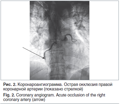 Рис. 2. Коронароангиограмма. Острая окклюзия правой коронарной артерии (показано стрелкой) Fig. 2. Coronary angiogram. Acute occlusion of the right coronary artery (arrow)