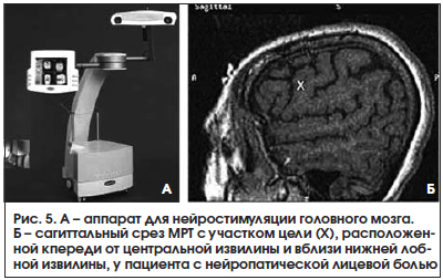 Рис. 5. А – аппарат для нейростимуляции головного мозга. Б – сагиттальный срез МРТ с участком цели (Х), расположенной кпереди от центральной извилины и вблизи нижней лобной извилины, у пациента с нейропатической лицевой болью