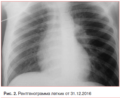 Рис. 2. Рентгенограмма легких от 31.12.2016