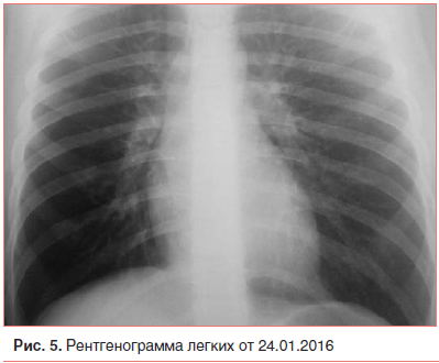 Рис. 5. Рентгенограмма легких от 24.01.2016