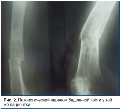 Рис. 2. Патологический перелом бедренной кости у той же пациентки