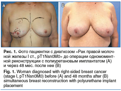 Рис. 1. Фото пациентки с диагнозом «Рак правой молоч- ной железы I ст., pT1Nsn0M0» до операции одномомент- ной реконструкции с полиуретановым имплантатом (А) и через 48 мес. после нее (В) Fig. 1. Woman diagnosed with right-sided breast cancer (stage I, pT