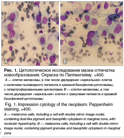 Рис. 1. Цитологическое исследование мазка-отпечатка новообразования. Окраска по Паппенгейму. ×400. А — клетки меланомы, в том числе двуядерная «зеркальная» клетка с наличием пылевидного пигмента и краевой базофилии цитоплазмы, с гипертрофированными нуклео